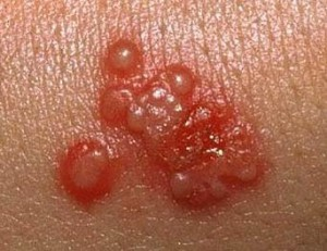 Illustration for article titled Obat Herpes